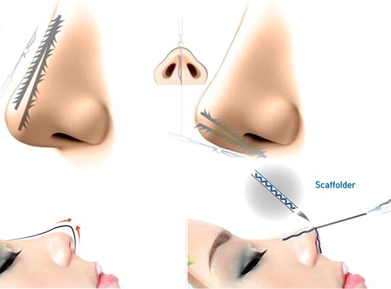 Nâng mũi bằng chỉ giúp dáng mũi cao và thon gọn hơn